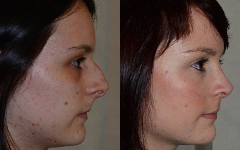 Hump reduction, tip refinement and reduction of columella