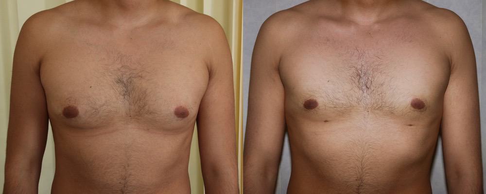 Male breast reduction