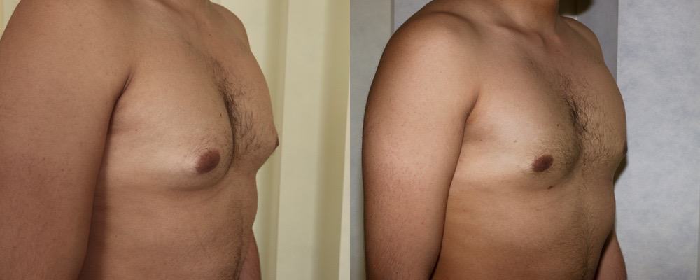 Male breast reduction