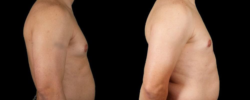 gynecomastia before after