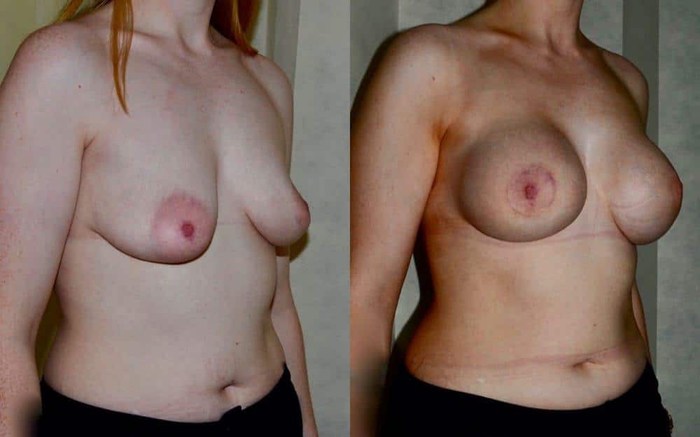 Breast augmentation