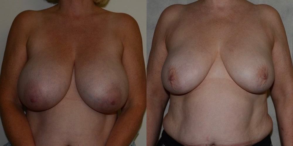 Breast Reduction without Scars