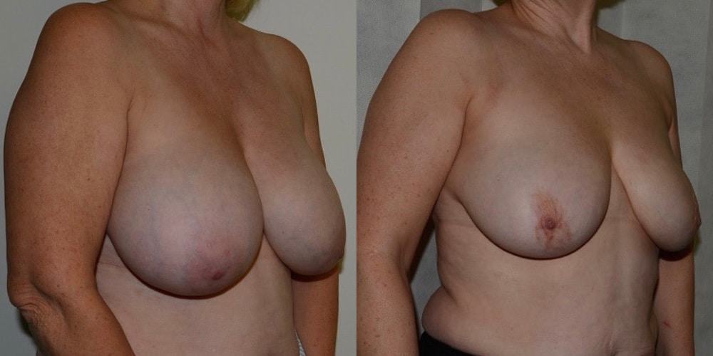 Breast Reduction without Scars