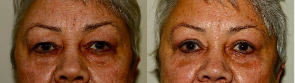 Upper and lower blepharoplasty