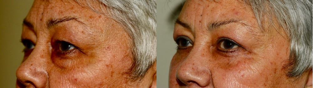 Upper and lower blepharoplasty