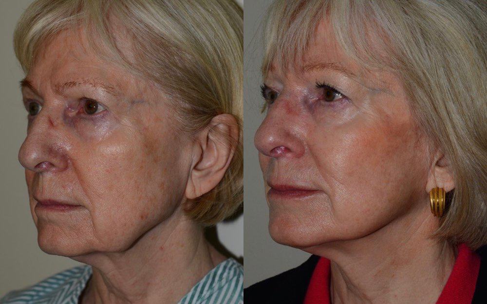 facelift surgery edinburgh