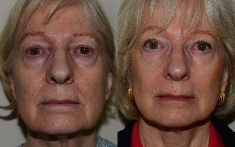 Lower face/ neck lift under local anaesthetic and sedation