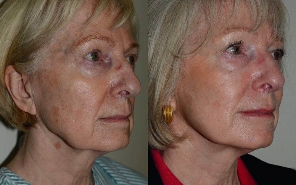 Lower face/ neck lift under local anaesthetic and sedation