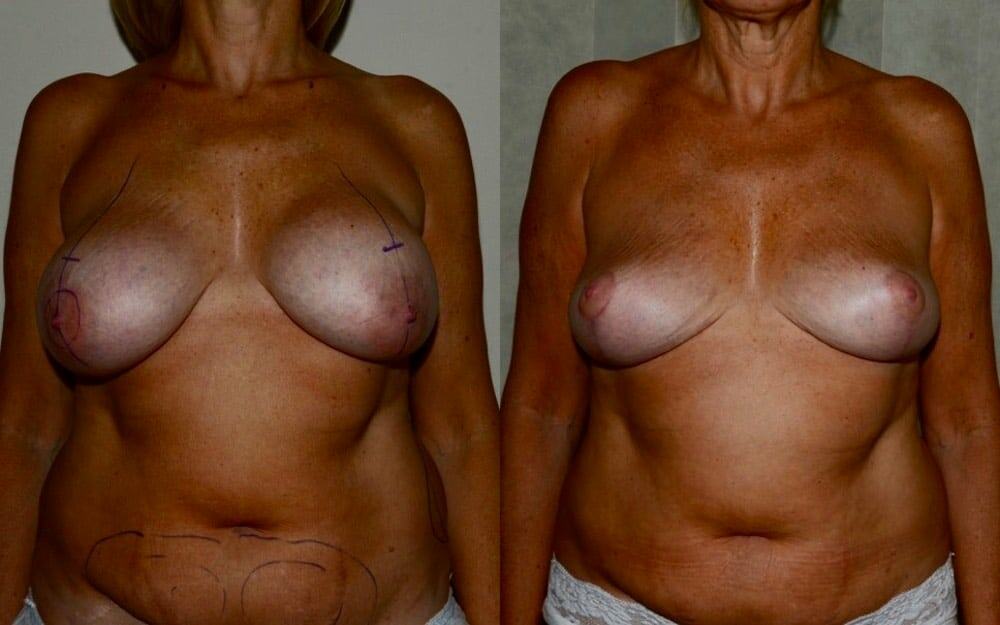 Removal of breast implants, breast uplift and fat transfer to the breasts