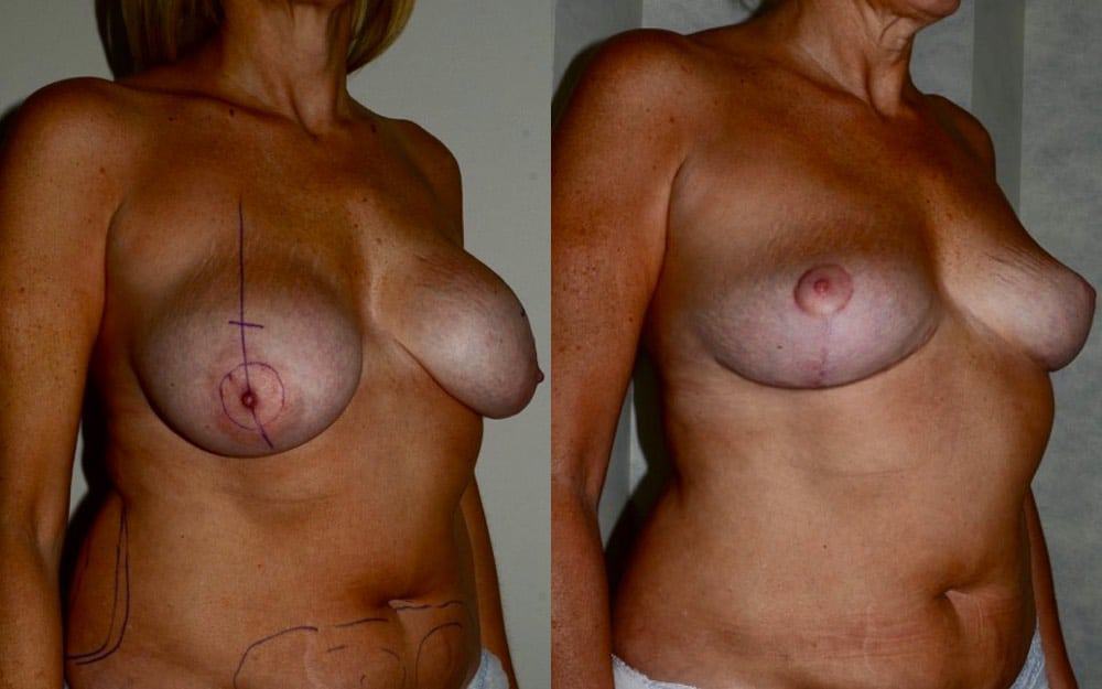 Removal of breast implants, breast uplift and fat transfer to the breasts