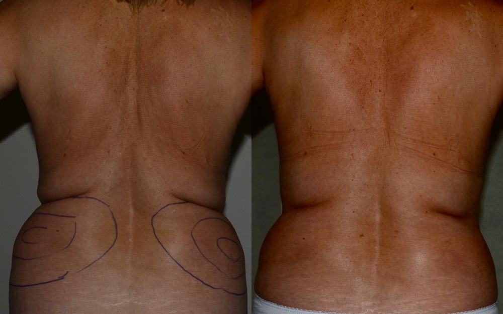 Removal of breast implants, breast uplift and fat transfer to the breasts