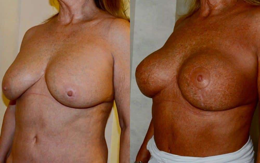 replace breast implants