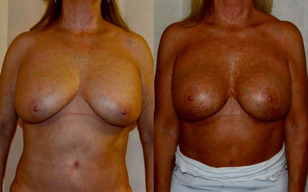 replace breast implants