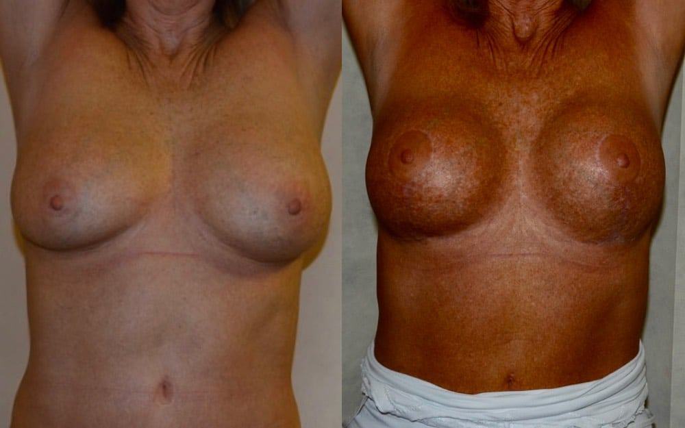 replace breast implants Scotland