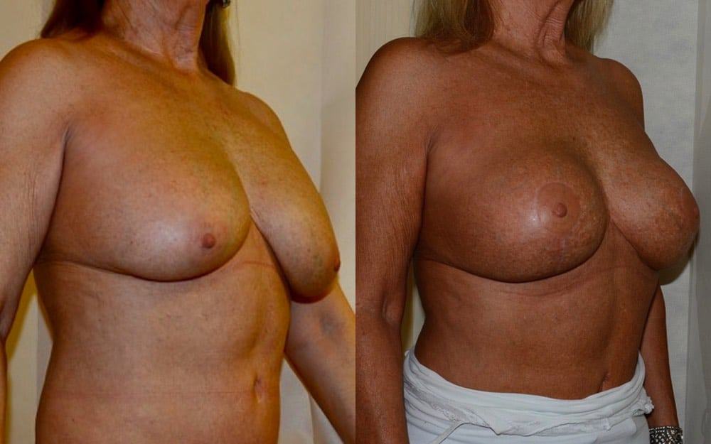 redo breast implant photos