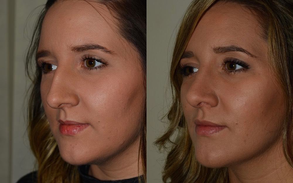 nose job photos