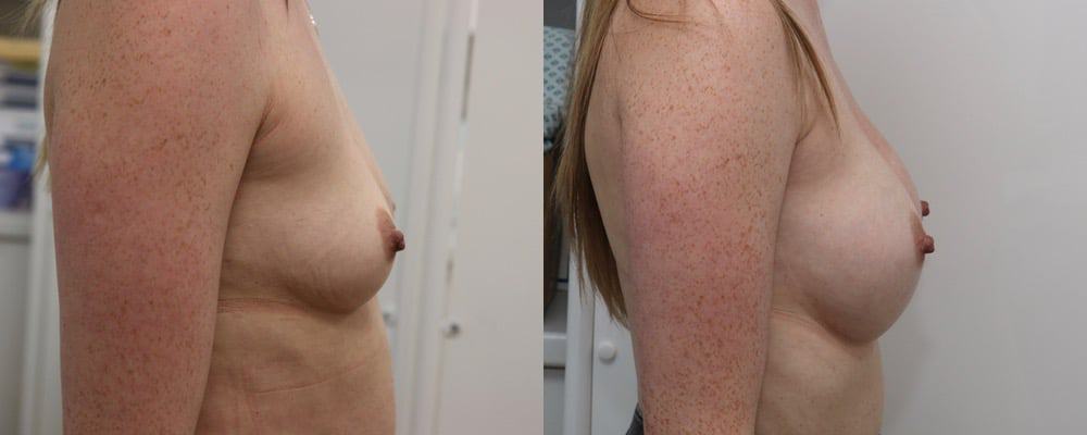 Breast enlargement