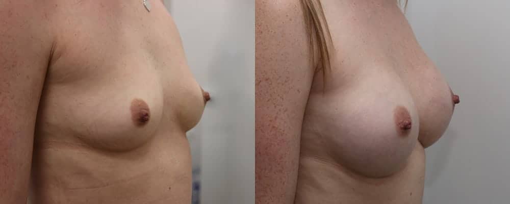 Breast enlargement