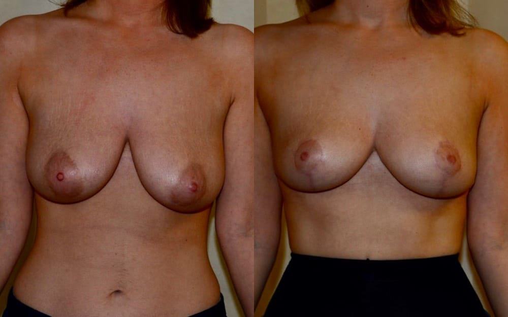 Breast reduction