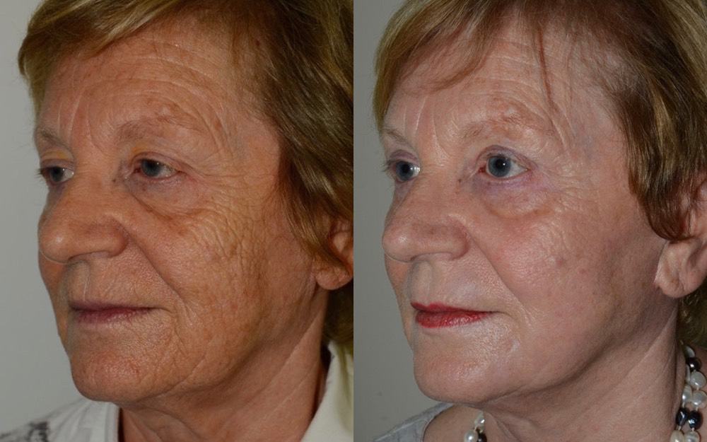 facelift surgeon scotland