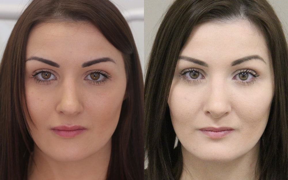 nose job tip reduction uk