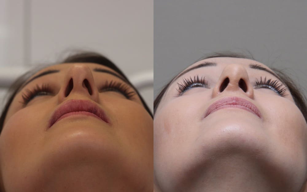 nose job tip reduction