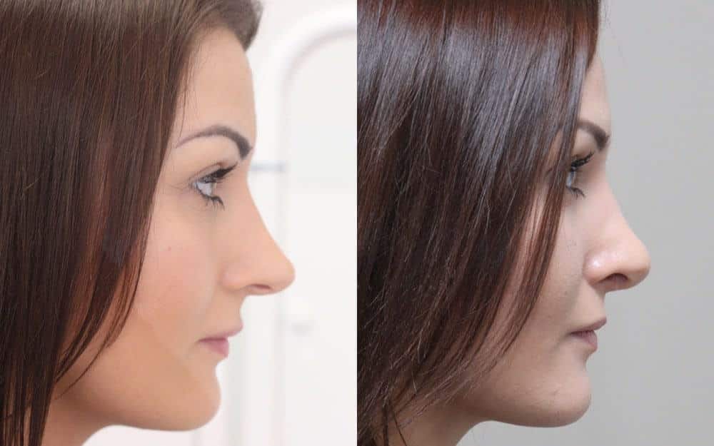 rhinoplasty uk