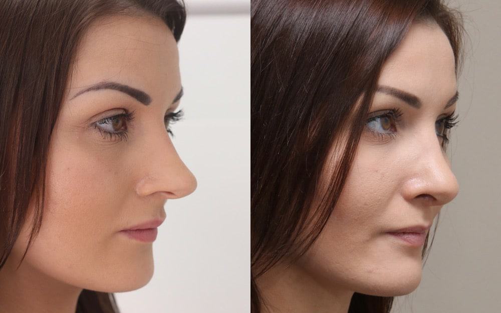 tip rhinoplasty