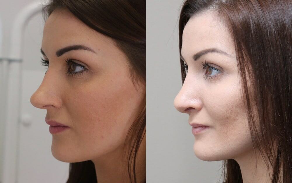 tip rhinoplasty