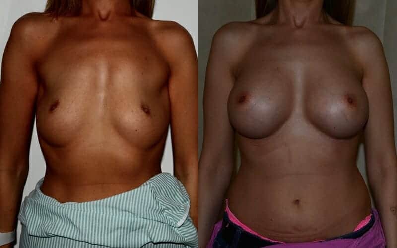 Breast Implants
