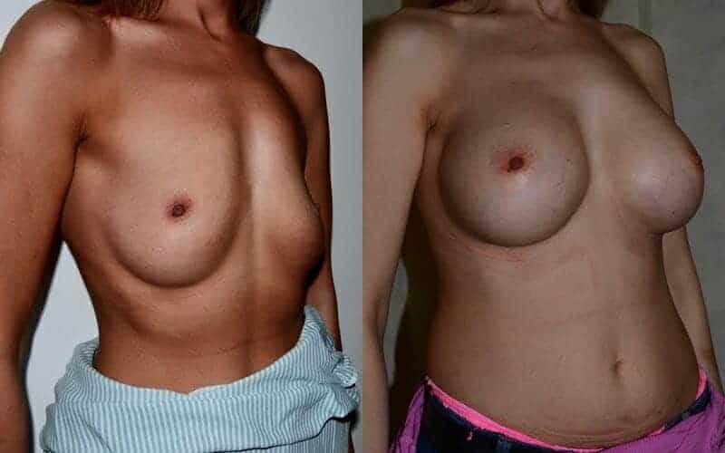 Breast Implants