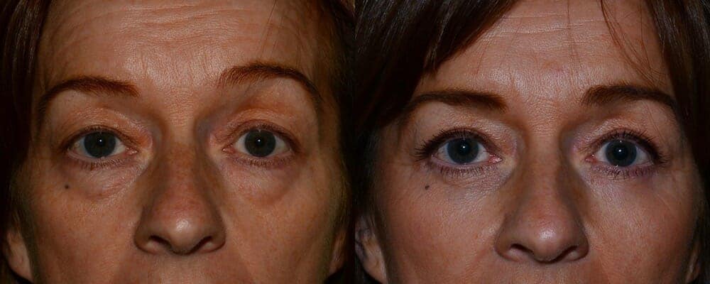 Upper and lower eyelid reduction