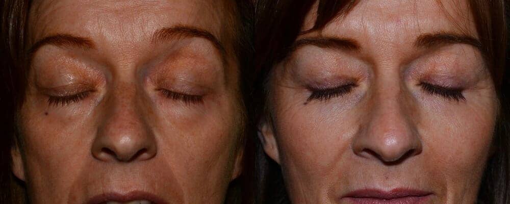 Upper and lower eyelid reduction