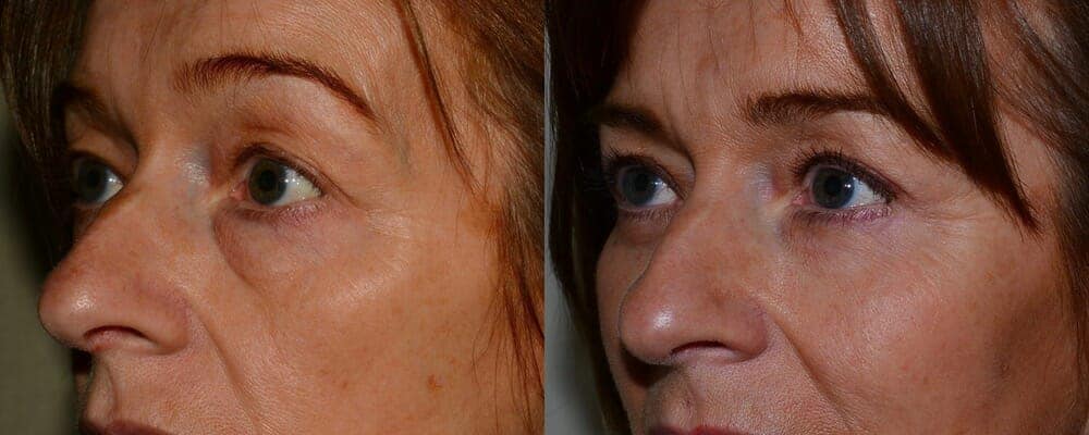 Upper and lower eyelid reduction