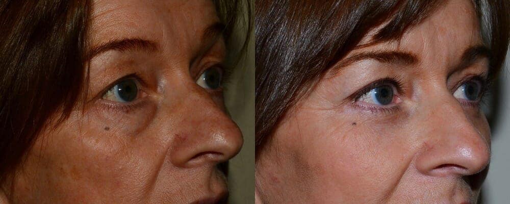 Upper and lower eyelid reduction