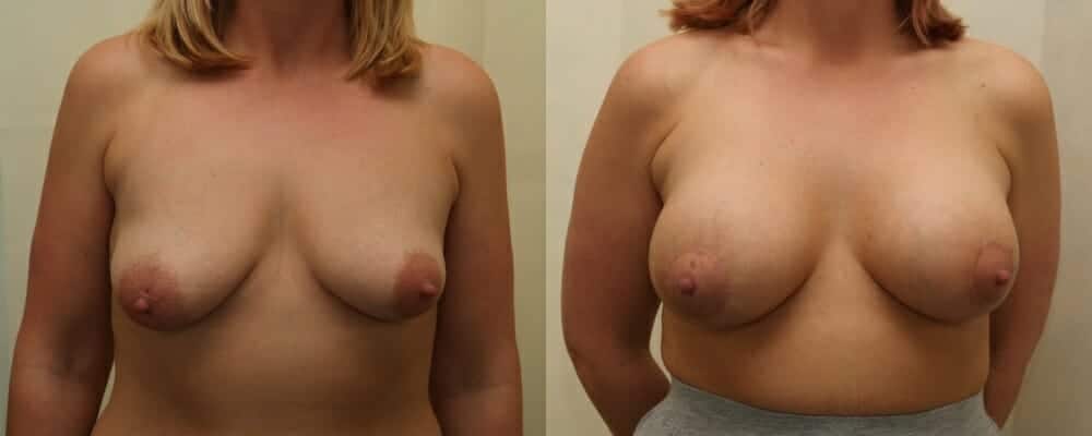 breast implants and nipple lift