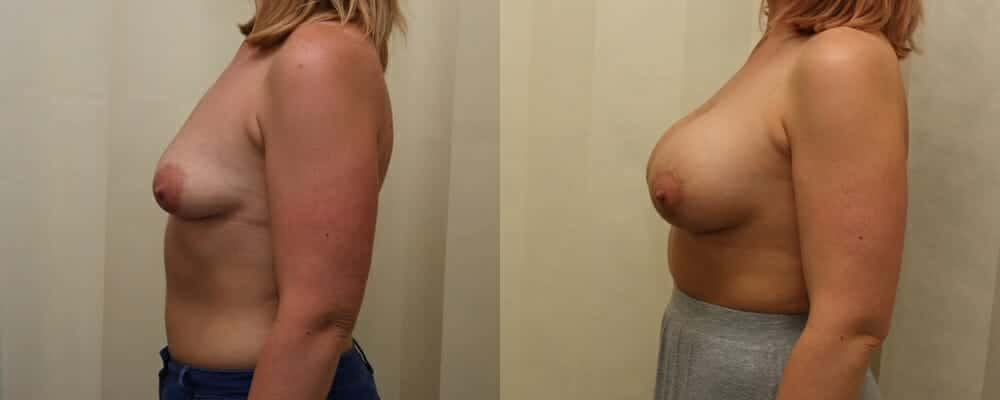 breast implants and nipple lift