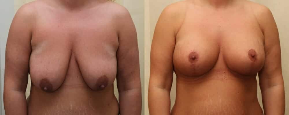 breast lift and implants