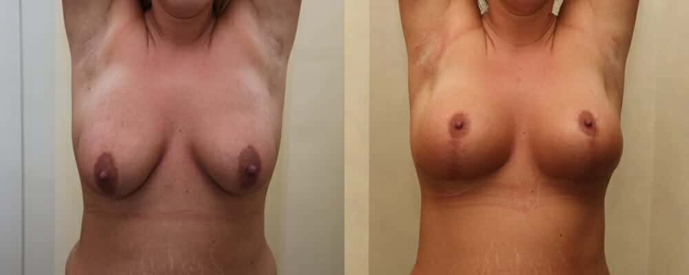 breast lift and implants