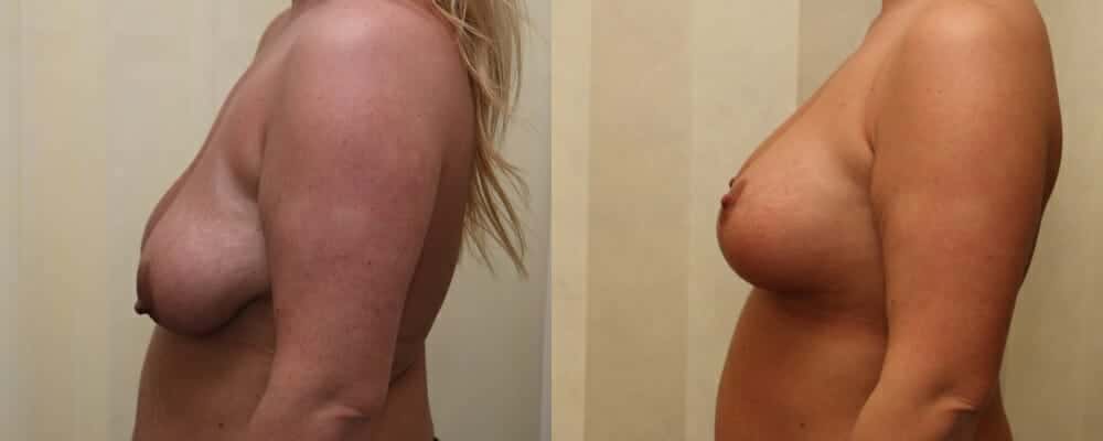 breast lift and implants