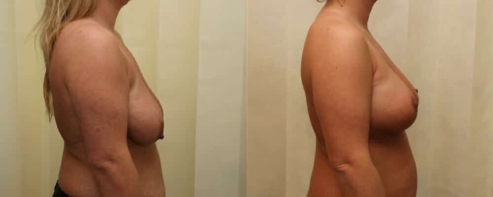 breast lift and implants