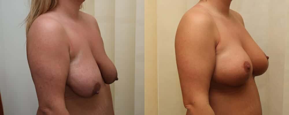 breast lift and implants