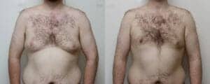 Gynaecomastia surgery scotland