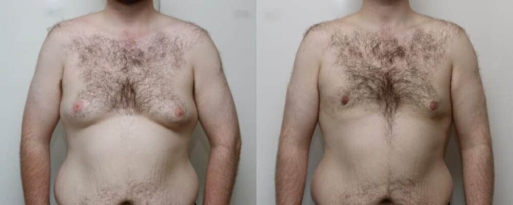 male breast reduction