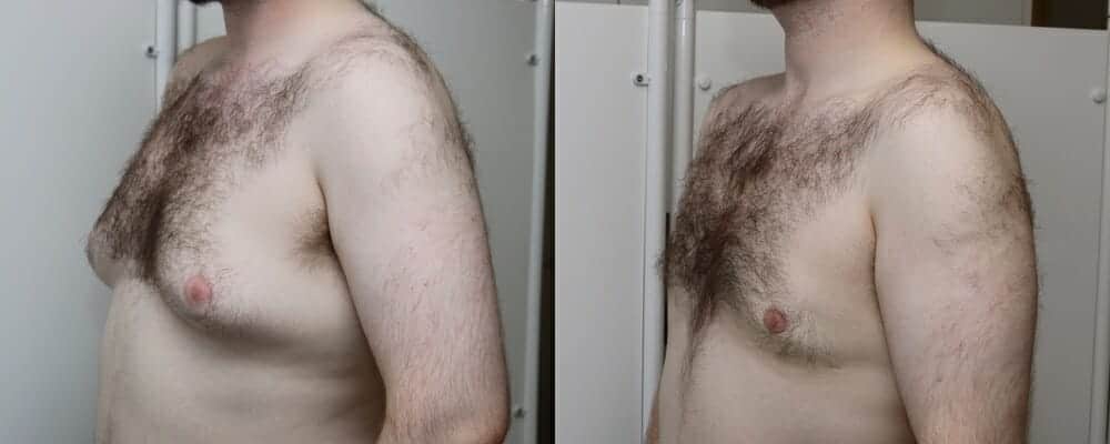 male breast reduction