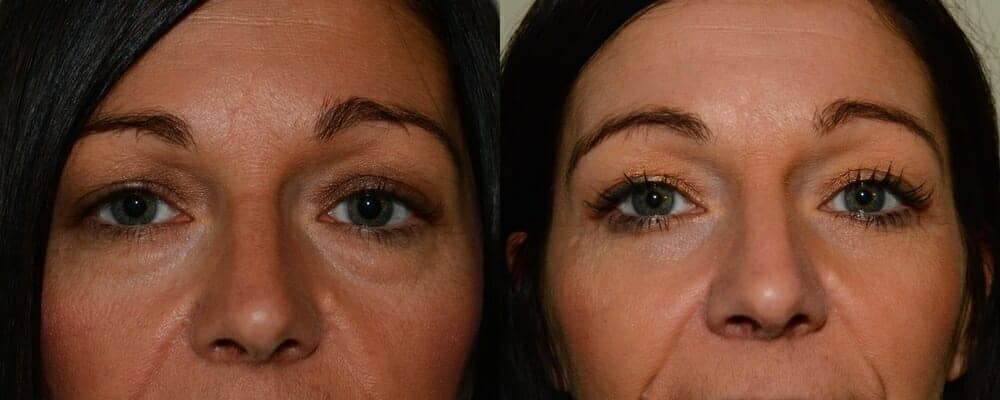 Upper and lower eyelid surgery