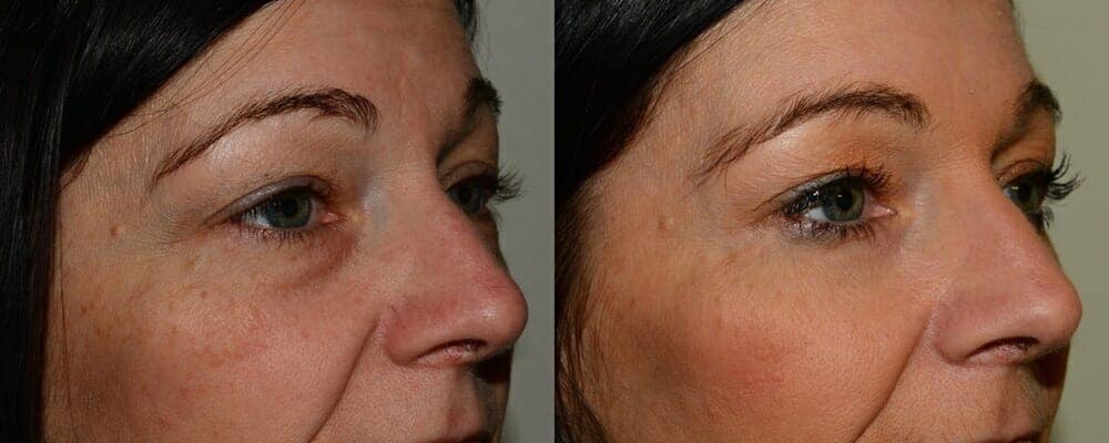 Upper and lower eyelid surgery