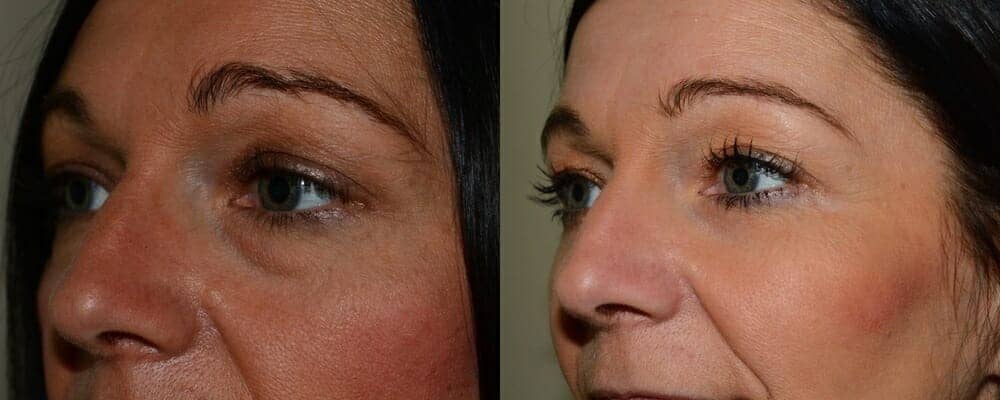 Upper and lower eyelid surgery