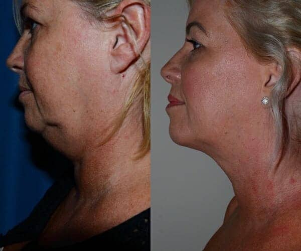 Neck liposuction