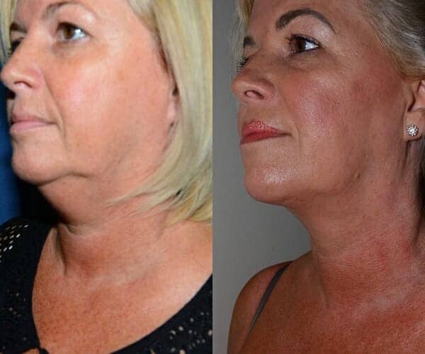 Neck liposuction